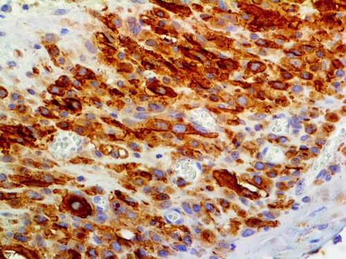 IHC of CD56 on an FFPE Neuroblastoma Tissue